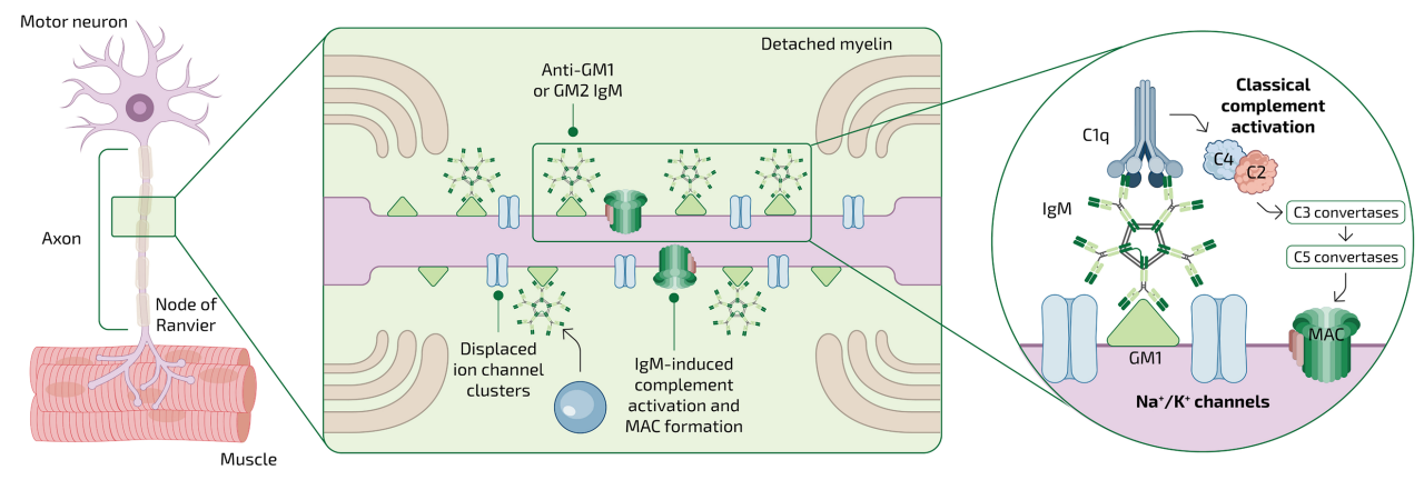 Proposed pathophysiology of MMN